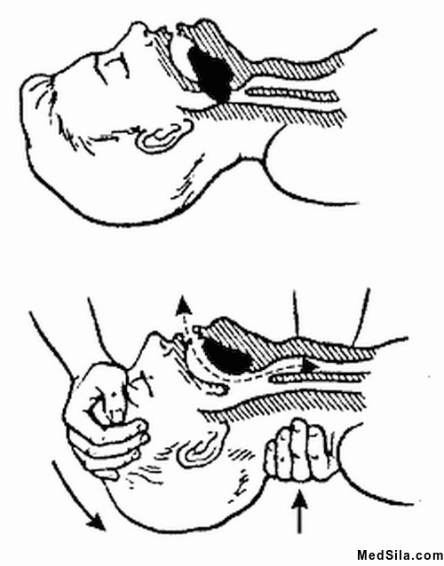 Запрокидывание головы человеку без сознания