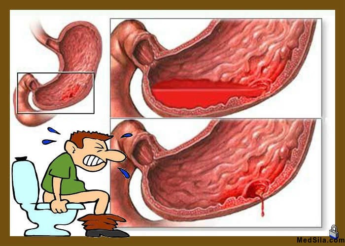 Кровотечение как осложнение ЯБЖ